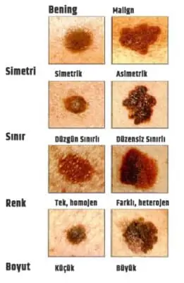 Ben Kanserinin Belirtileri Nelerdir?