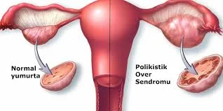 Polikistik Over Sendromu Belirtileri ve Polikistik Nedir?