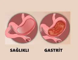 Gastrit Nedir ve Belirtileri Nelerdir?